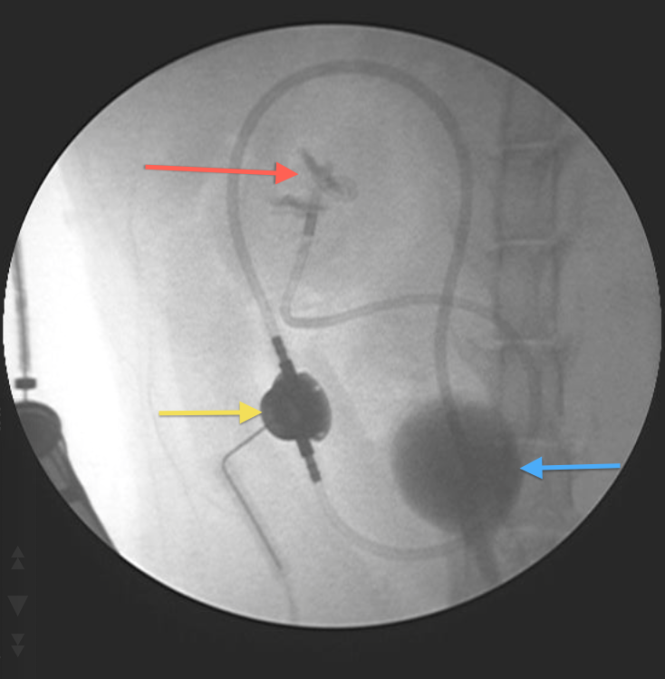 intraoperative fluoroscopy picture 
